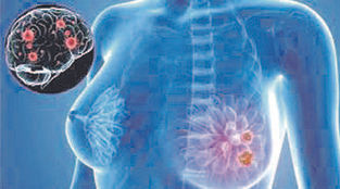 Presentan datos combinación fase 2 Elacestrant en pacientes con cáncer de mama metastásico