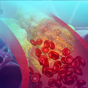 Hypercholestérolémie