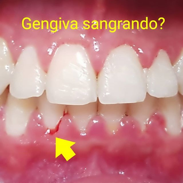 Gengiva Sangrando Ao Passar Fio Dental Gengiva Sangrando