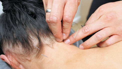 Acupuncturist performing neck pain treatment on a patient to relieve muscle tension and improve mobility.