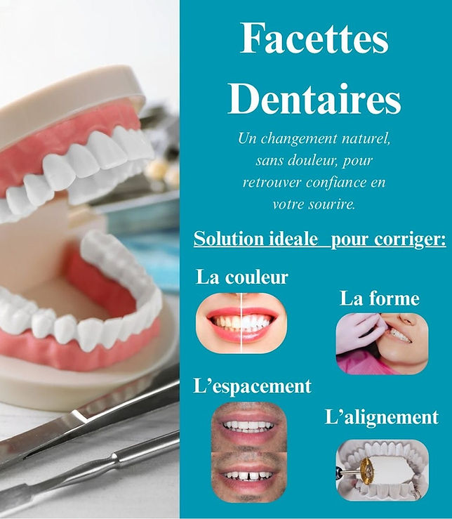 Facettes dentaires