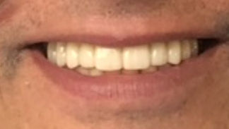 Restauration complète sur implants en zirconium