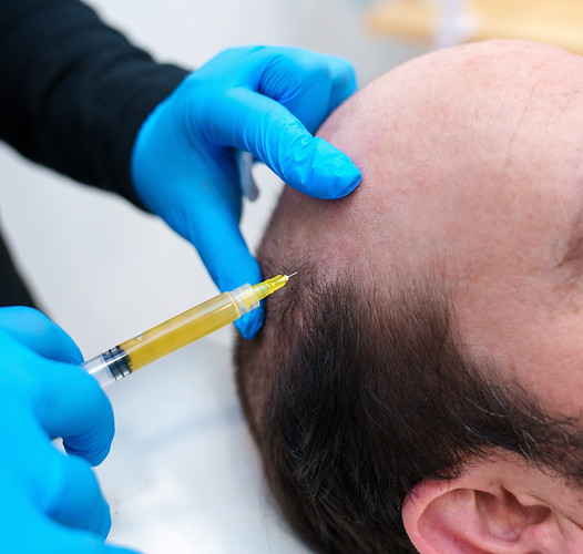 A clinician administers PRP injection to patient's scalp..jpg