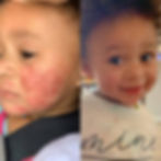 before and after picture of kid with eczema