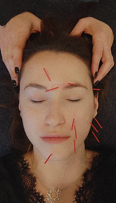 acupuntura