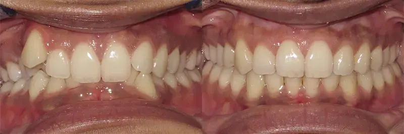 before and after of orthodontic care
