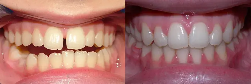 before and after of orthodontic care
