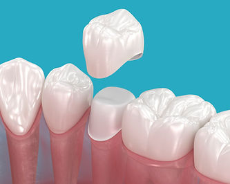 3D illustration of dental crown