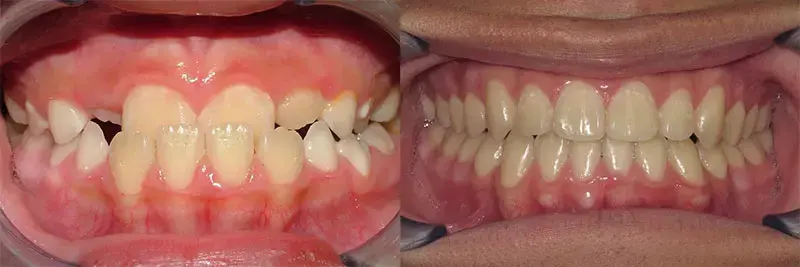 before and after of orthodontic care