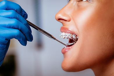 braces
