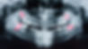 dental xray showing wisdom teeth