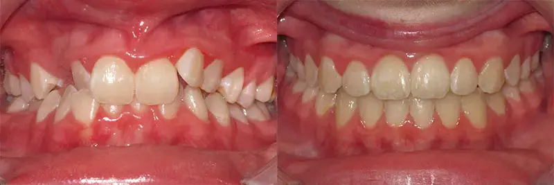 before and after of orthodontic care