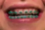 close up on a smile with braces