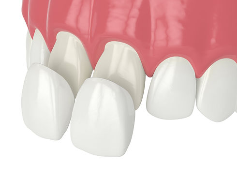 3d illustration of veneers