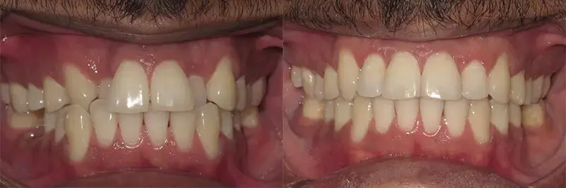before and after of orthodontic care