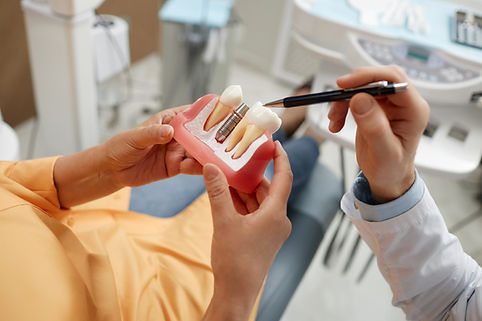 denture implants