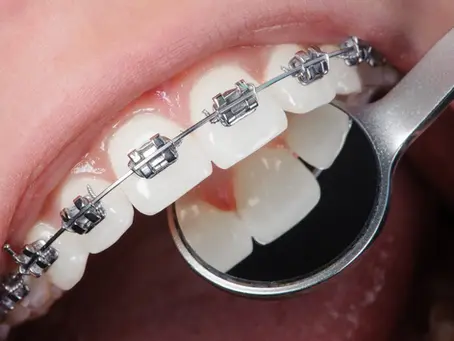 closeup on braces