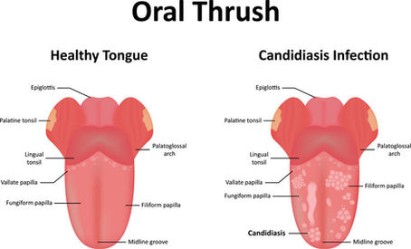 Understanding Thrush: Causes, Symptoms, and Treatment
