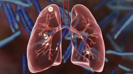 Understanding Pulmonary Nodules: A Guide to the Fleischner Guidelines