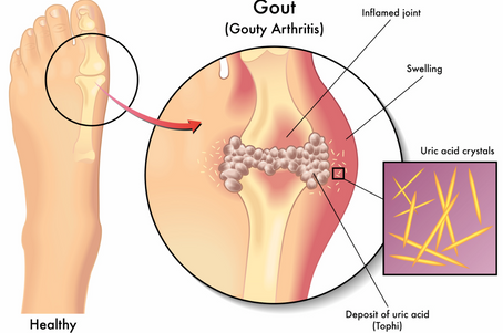 Understanding Gout: Symptoms, Risk Factors, Diagnosis, and Treatment