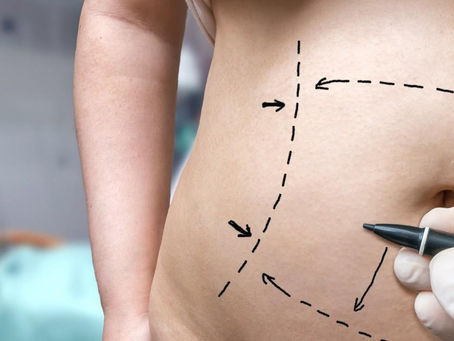 The Science Behind Laser Liposuction In Riyadh: An In-Depth Look