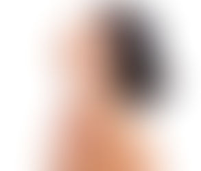 Is Profound RF Treatment Better Than a Facelift?