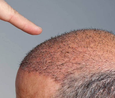 زراعة الشعر لمرضى العلاج الكيميائي: هل هي ممكنة؟