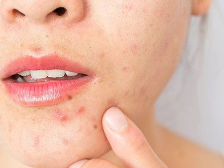 Comprehensive Guide to Effective Body Acne Treatment