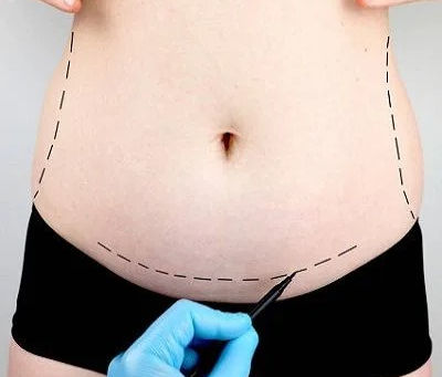 Is Lipomatic Better Than Traditional Liposuction?