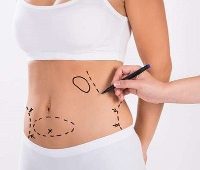 Can I Still Use Waist Trainers Post-Surgery?