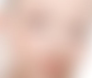 Dysport for Eyebrows: Lifting and Relaxing Muscles for a Fresh Look