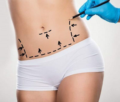 Will My Skin Snap Back After Waist Sculpting?