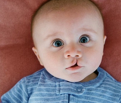 Best Age for Palate Repair Surgery: What Experts Say