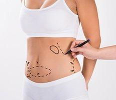 Best Tummy Tuck Surgery Clinic In Muscat And Choosing Between Full and Mini Tummy Tucks