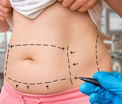 What Happens If You Gain Muscle After Lipomatic?