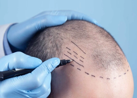 The Future of FUE Hair Transplant: A Comprehensive Overview