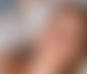 How to Avoid Overfilling with Jawline Filler Injections