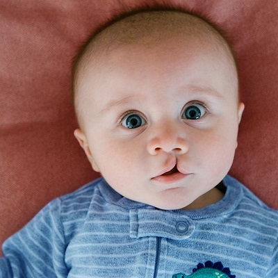 جراحة إصلاح الحنك في مسقط