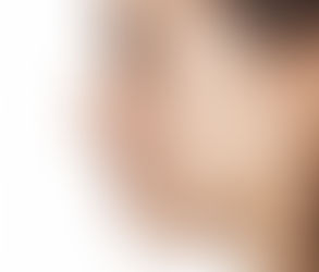 Acne Treatment for Athletes: Unique Challenges and Solutions