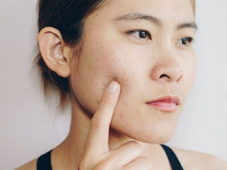 Breaking Barriers: Inclusivity and Diversity in Acne Scar Treatment Narratives