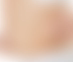 Is Lipomatic Surgery Safe for Everyone?