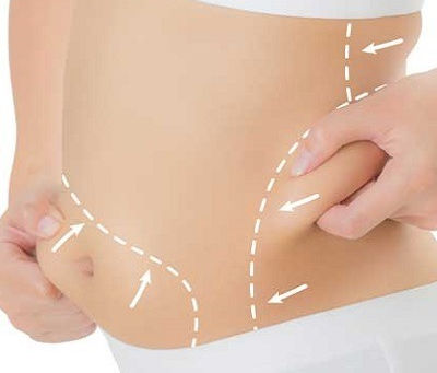 Is Lipomatic Surgery Safe for Everyone?