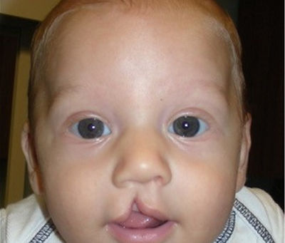 Tips for a Smooth Recovery Post-Surgery: Best Palate Repair Surgery Muscat