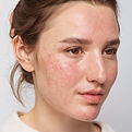 rashes on face.jpg