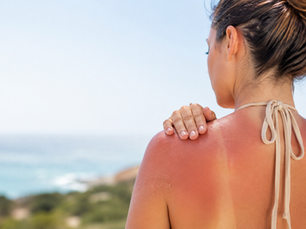 Sunburn Care: What Helps, What Hurts, and When to Get Checked