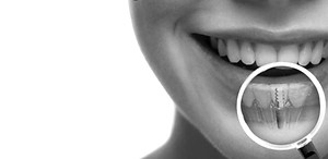 dental-implants1_edited.jpg