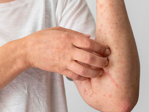 “La falta de vacunación ha ocasionado aumento de casos de sarampión en México”: Dr. Arturo Mendoza