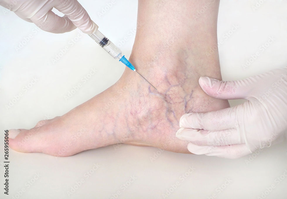 A doctor injecting a venous foot with a syringe