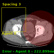 appendicitis_0093.gif