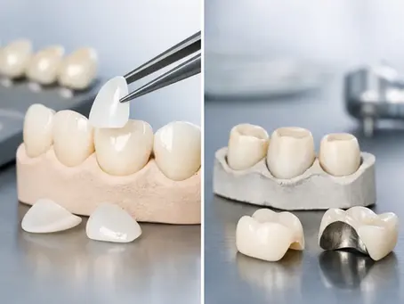 Carillas dentales vs coronas dentales, cuál elegir